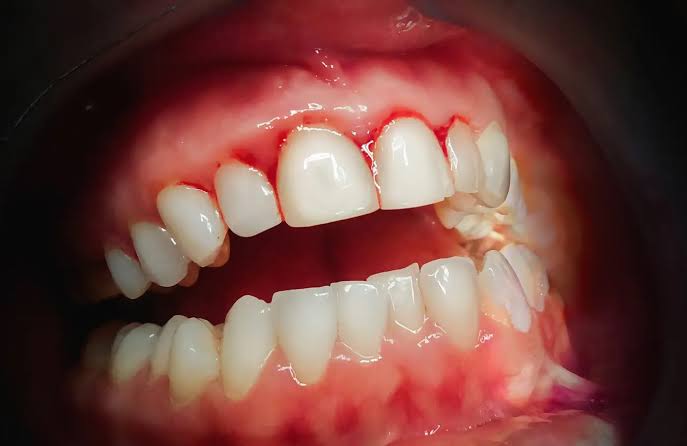 Brief Write-up On Diagnosis of ANUG Acute Necrotising Ulcerative ...